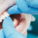 close-up-of-female-mouth-with-retractor-doctor-PWRQ6FA