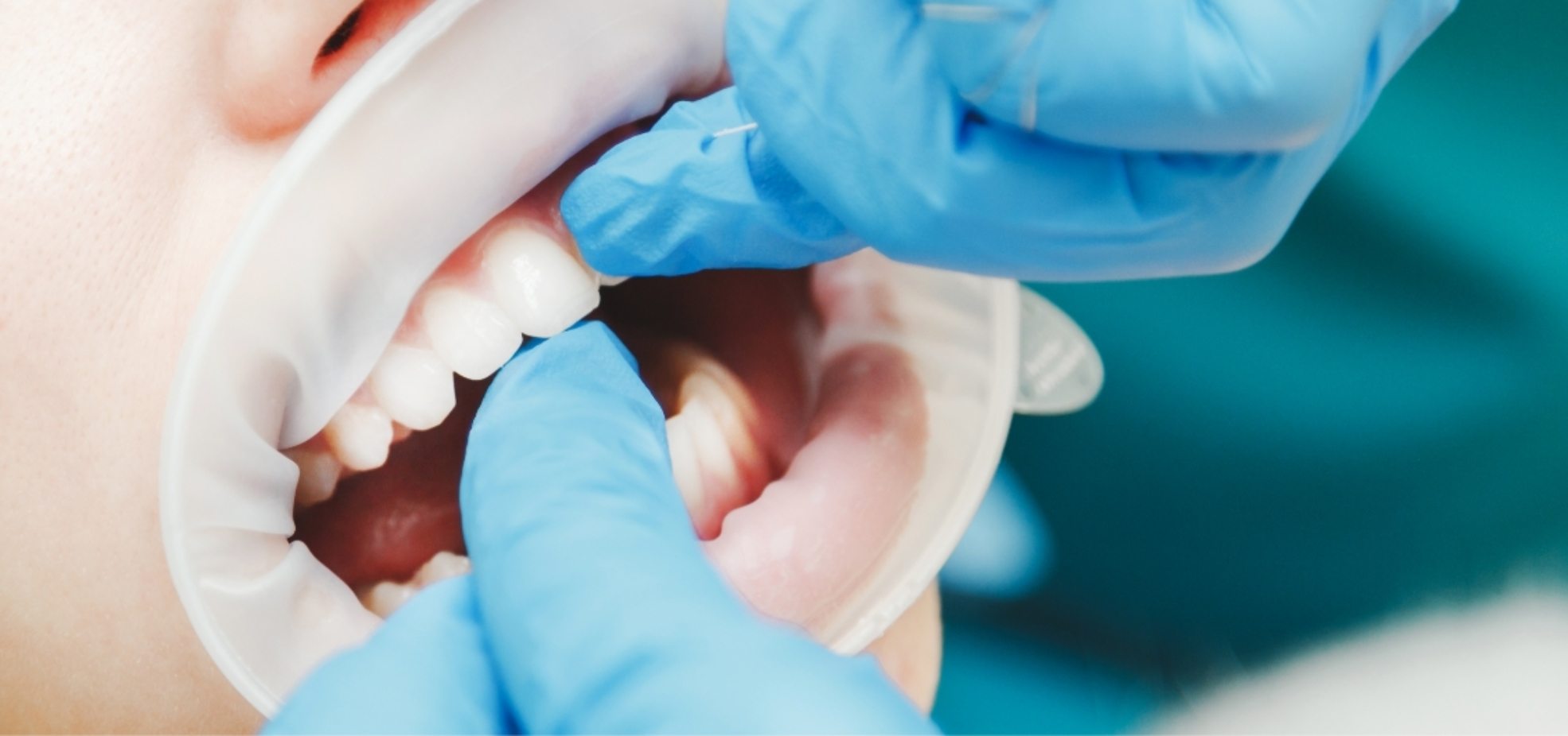 close-up-of-female-mouth-with-retractor-doctor-PWRQ6FA