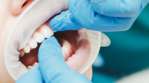 close-up-of-female-mouth-with-retractor-doctor-PWRQ6FA